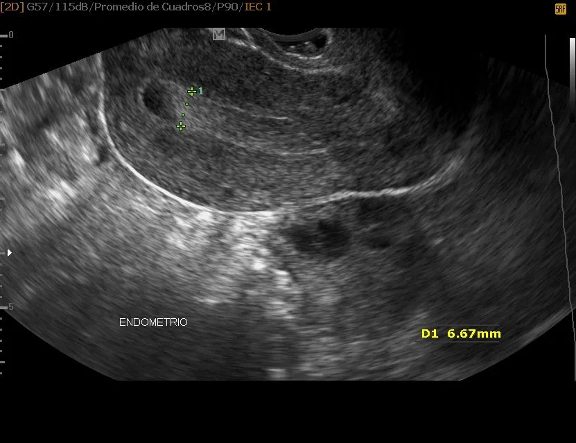 US giecologico endometrio